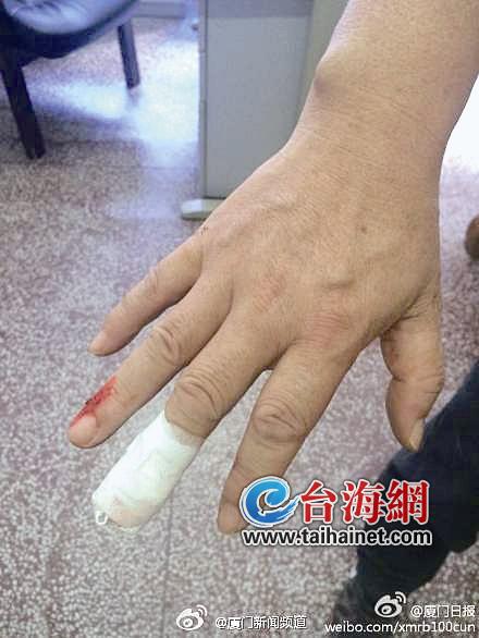 李志龙的手指受伤
